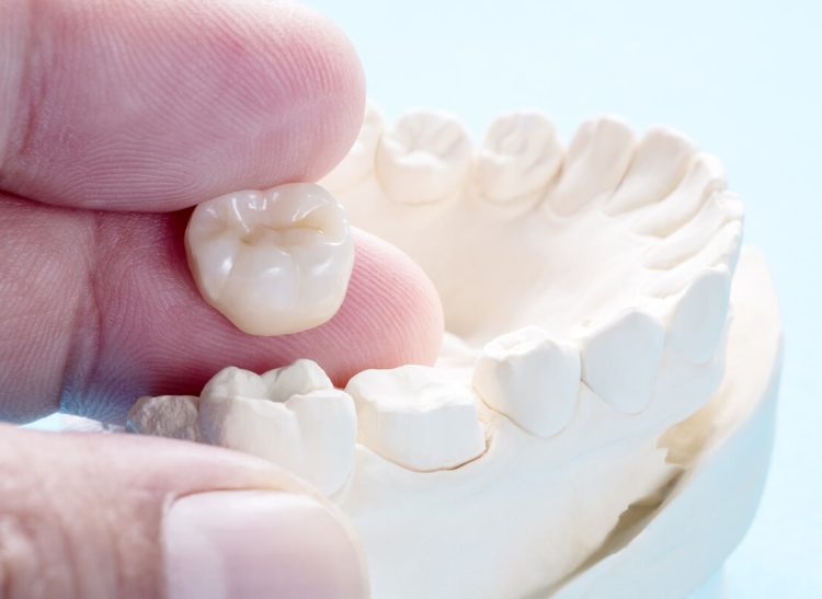 the-pros-and-cons-of-dental-crowns